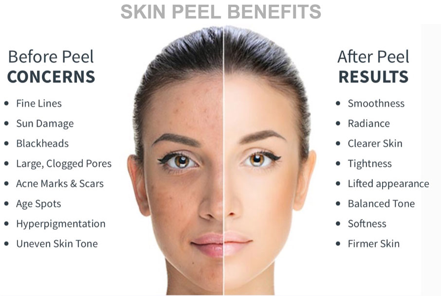 The benefits of Chemical Peels.
